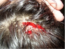 Herping accident