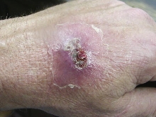 Recluse Bite