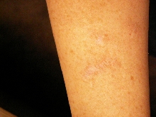healed wound inflicted by salvadorii