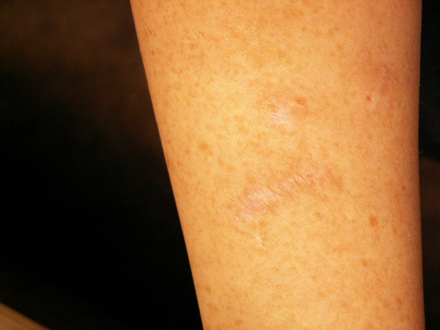 healed wound inflicted by salvadorii