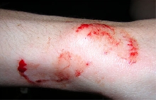 black ratsnake bite