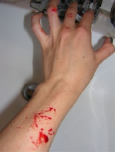 Climacophora bite