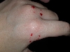 Anubis bite