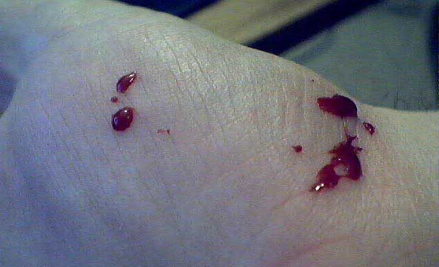 closeblood
