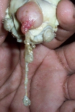 torn sac?