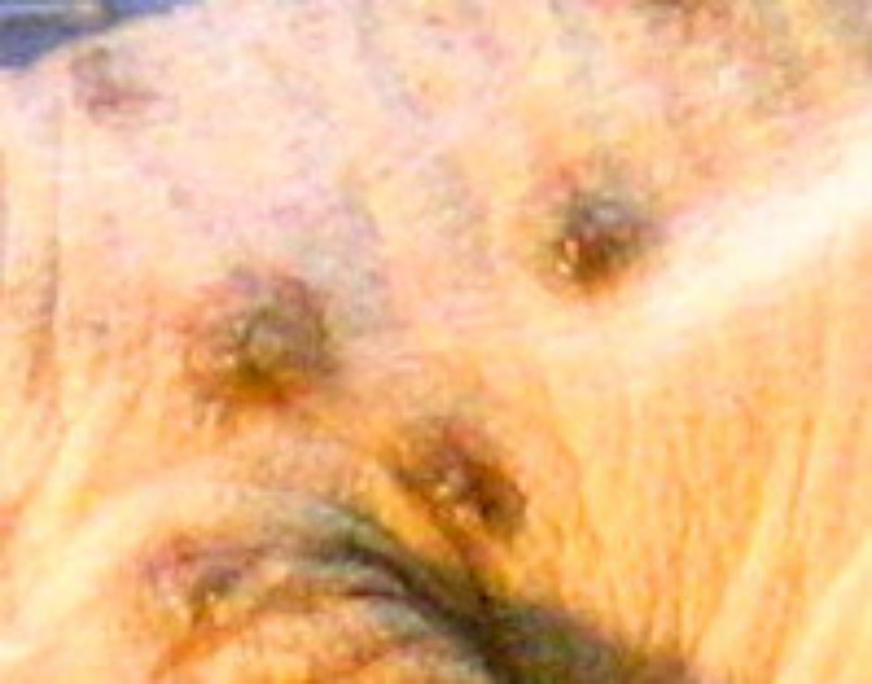 pox