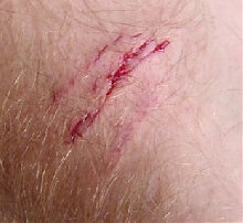 Bite wound