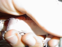 Choch Thumb