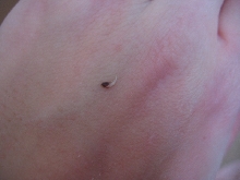 The Toenail