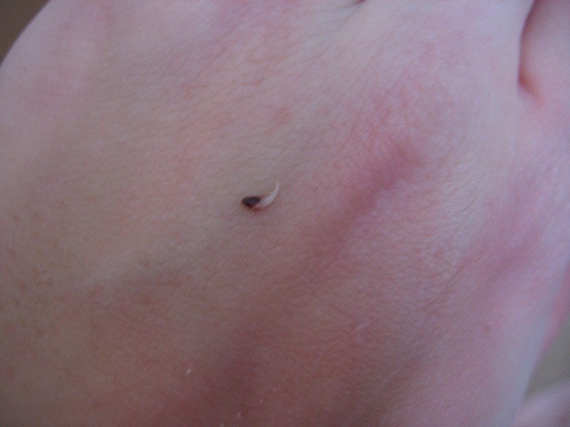 The Toenail