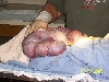 C Section
