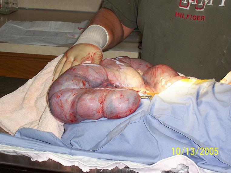 C Section