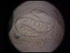 hookworm